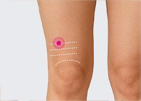 梁丘 りょうきゅう ツボ 膝の痛みや違和感に効果